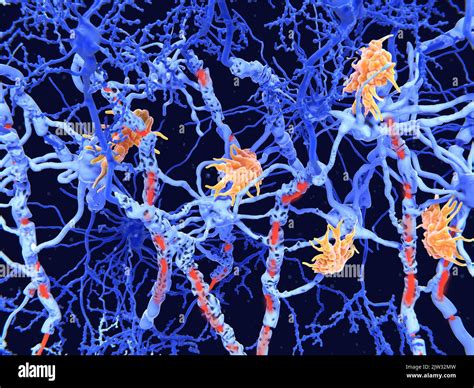 Illustration of damaged nerve cells caused by the degenerative disease multiple sclerosis ...