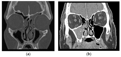 Aspergillus Sinusitis: Risk Factors and Phenotyping