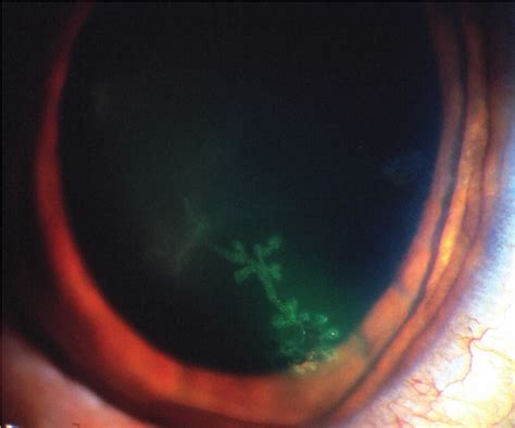 Herpes, causes, signs, symptoms, diagnosis, treatment & prognosis