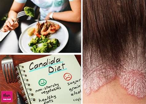 फंगस इंफेक्शन से बचाव करेगी कैंडिडा डाइट, जानिए 4 जरूरी बातें - candida ...