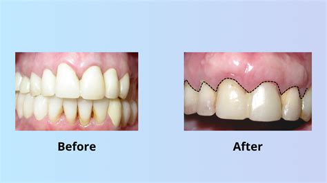 Gum Tissue Graft Cost With Insurance at Rocio Wilds blog