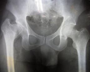 Hip Replacement: Rheumatoid arthritis treatment in Chennai | Ceramic ...