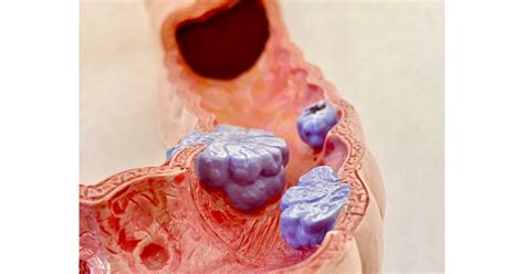 Image result for Colonoscopy Polyps Types