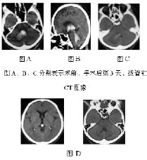 侧脑室外引流治疗小脑出血破入脑室21例观察--中国期刊网