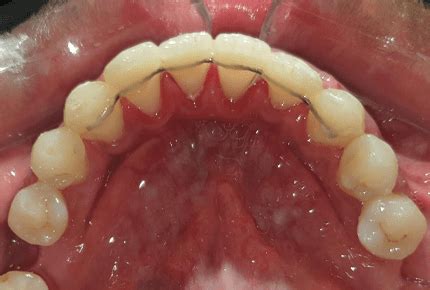 Image result for Retainer Problems