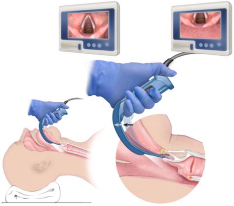Image result for Intubation Using GlideScope