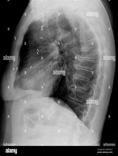 Film xray or radiograph of a mid back thoracic vertebrae . Lateral side ...