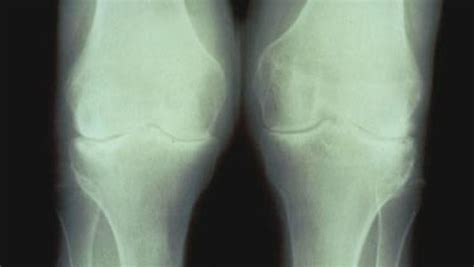 MOST Study: End Stage Knee Osteoarthritis Shows Dynamic Change by MRI ...