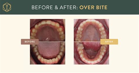 What Can Braces Fix? 9 Ways They Can Improve Your Smile — Shoe Orthodontics Hanover, PA ...