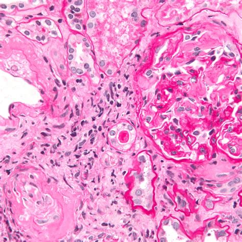 Amyloïdose rénale - Contenu en francais - Universimed - Medizin im Fokus