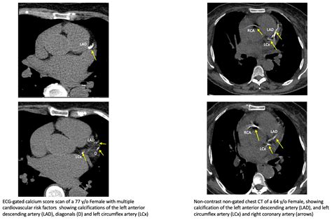 Artificial Intelligence in Coronary Artery Calcium Scoring Detection and Quantification