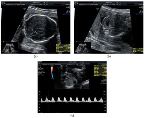 Single Fetal Demise in Twin Pregnancy—A Great Concern but Still a ...