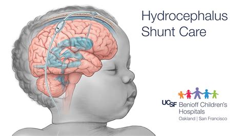 Hydrocephalus Shunt