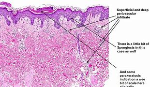 Image result for perivascular