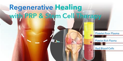 End Joint Pain with Minimally Invasive Platelet Rich Plasma (PRP) and Stem Cell Therapy at ...