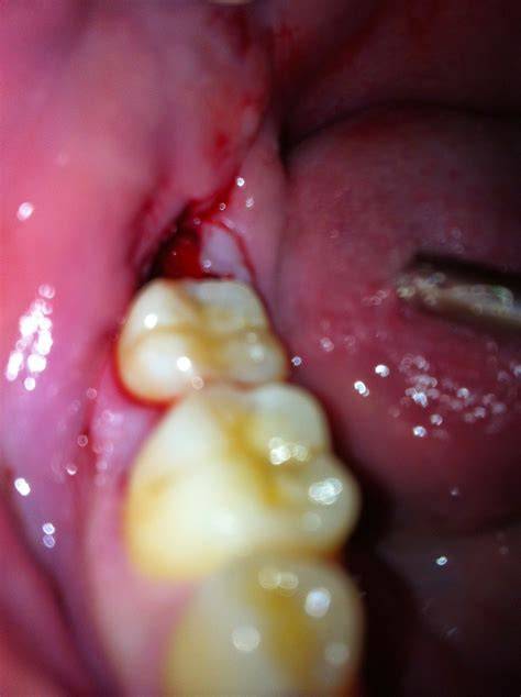 What Does A Normal Wisdom Tooth Blood Clot Look Like at Rose Longstaff blog