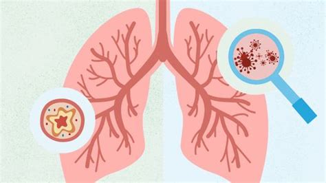 Bronchitis vs. Pneumonia: What’s the Difference?