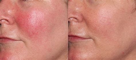 Best Laser For Rosacea Flushing at Pauline Dane blog