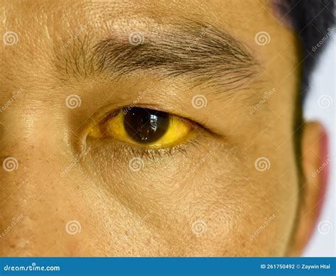Jaundice Eye Diseases at Jeremy Tellez blog