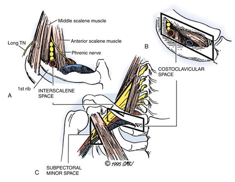Thoracic Outlet Compression Syndrome - Clinical Tree
