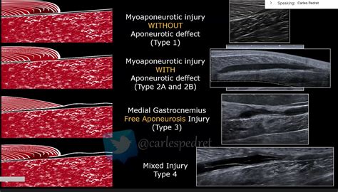 Gastrocnemius Tear Ultrasound