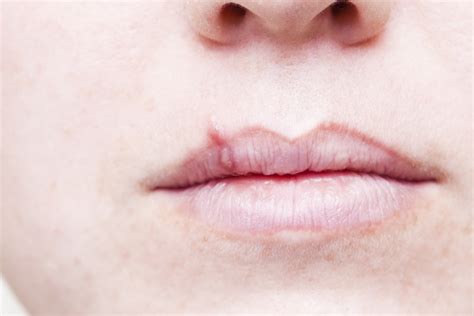 Almost everyone has oral herpes, including me