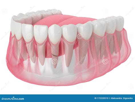 3d Render of Jaw with Cracked Tooth Root Stock Illustration - Illustration of fractured, break ...
