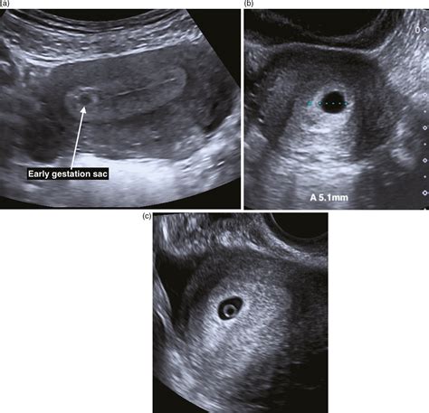 Ectopic Pregnancy Ultrasound 8 Weeks