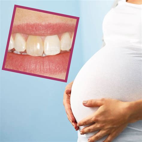 Can You Whiten Teeth While Pregnant? – Eliottmen