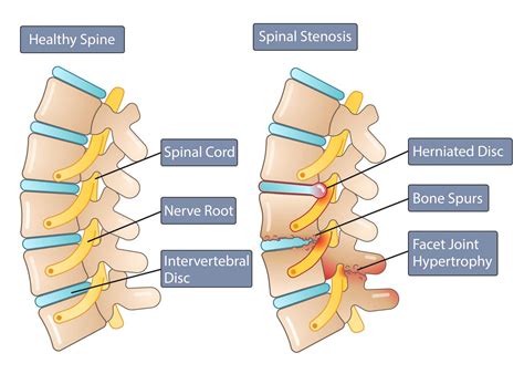 Spinal Canal Stenosis Icd 9 - mapasgmaes