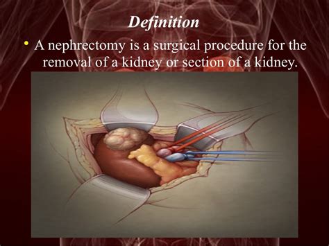 Image result for Nephrectomy Approach