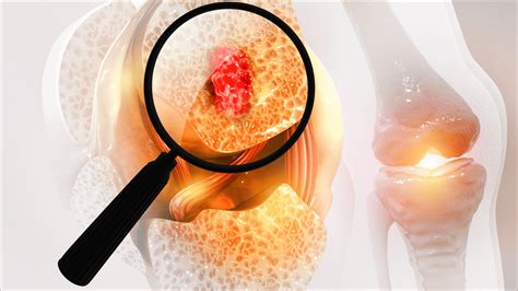 Cancer En Los Huesos Espanol Osteoma Osteoide: Qué Es, Síntomas Y