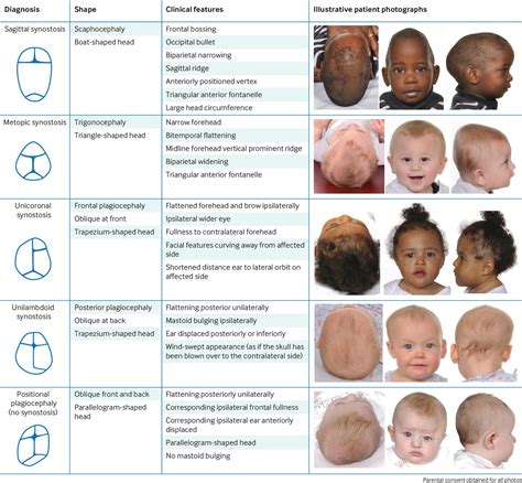 Recognising a child with isolated craniosynostosis | The BMJ