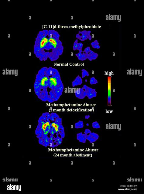 Rezultat imagine pentru Dat Brain Scan