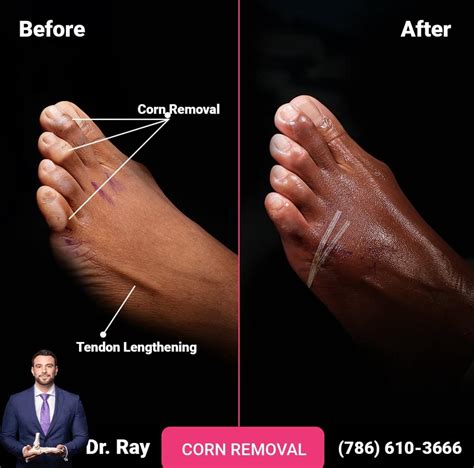 Corn Removal Surgery Before and After Photos - Luxe Foot Surgery