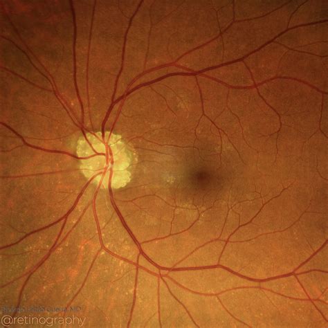 Optic disc drusen – Retinography