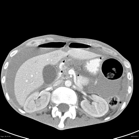 Stomach Ulcer Ultrasound