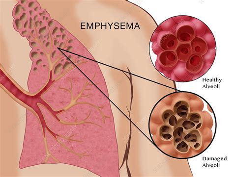 Image result for Emphysema Example