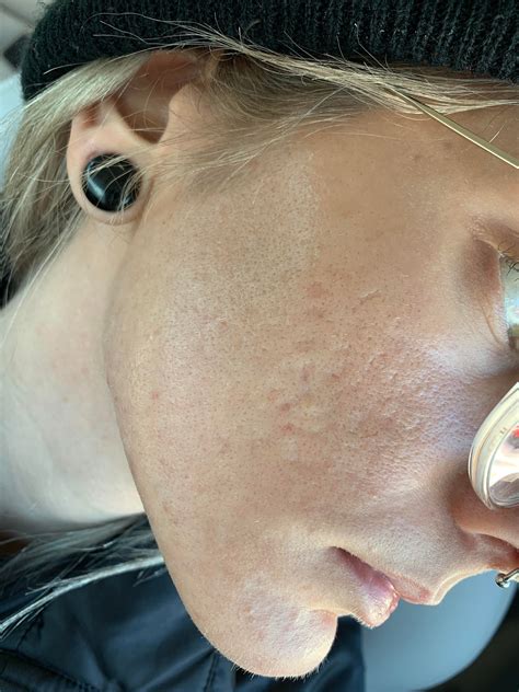 [skin concerns] does this look like a damaged moisture barrier? it ...