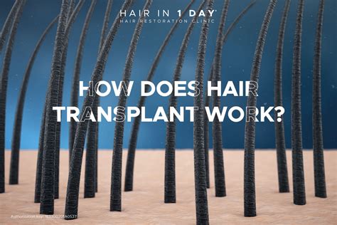 HOW DOES HAIR GRAFTING WORK? - Hair in 1 Day