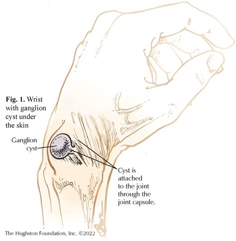 Image result for Elbow Cysts Explode