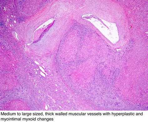 Pathology Outlines - Focal nodular hyperplasia