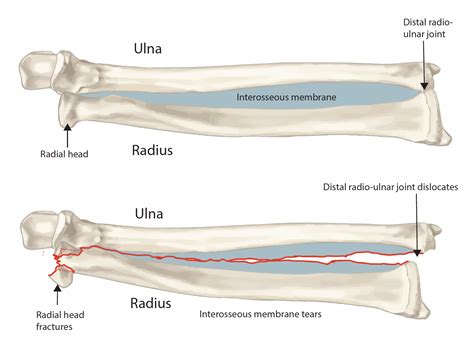 The Essex Lopresti Injury – Fife Virtual Hand Clinic