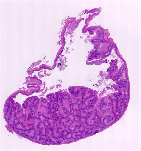 Pathology Outlines - Proliferating pilar cyst