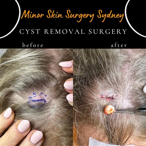 Cyst Surgery, Cyst Removal, Cyst Treatment Sydney