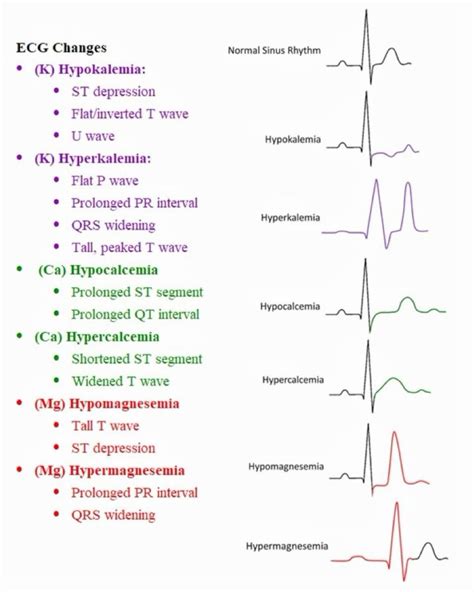Ecg interpretation review 13 bbb wide qrs is this lbbb vs rbbb vs ivcd ...
