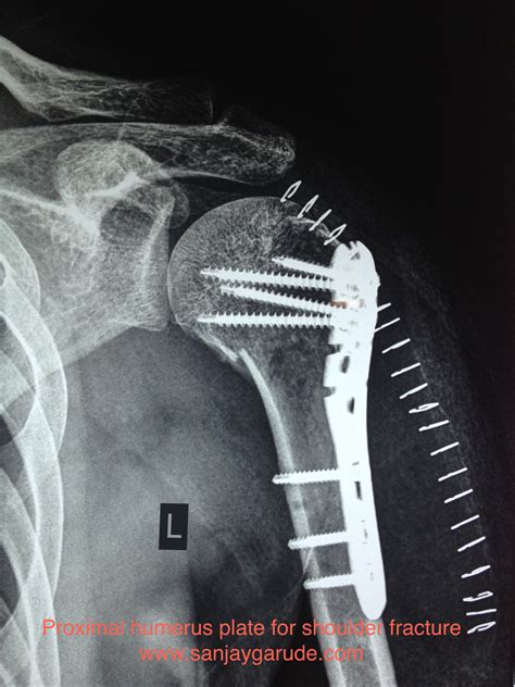 Shoulder Fractures | Dr. Sanjay Garude