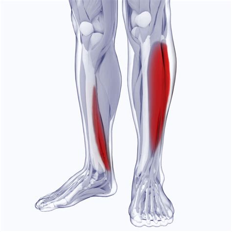 Medial Tibial Stress Syndrome Prevention