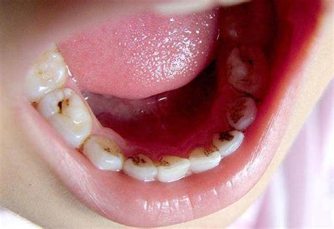 满口种牙能吃什么种满口牙多少颗最好2022已更新今日资讯