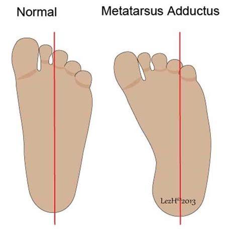 Metatarsus Adductus